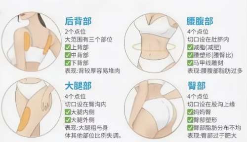 抽脂