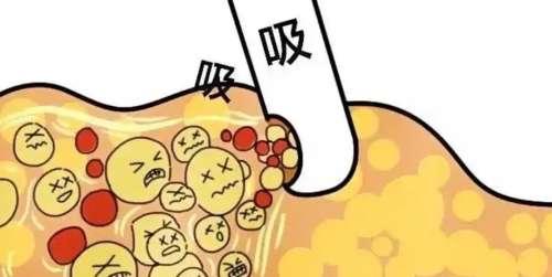 吸脂