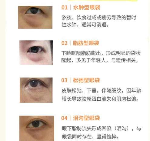 眼袋7.jpg