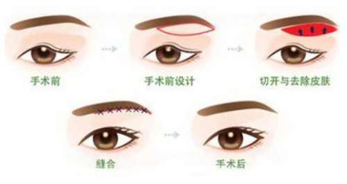肿眼泡