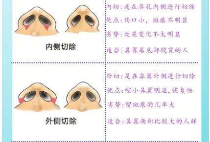 隆鼻7.jpg 隆鼻7.jpg