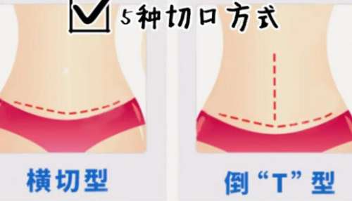 腹壁整形 腹壁整形