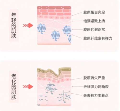 注射胶原蛋白