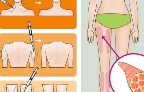 大腿吸脂01.jpg