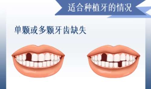 牙齿种植