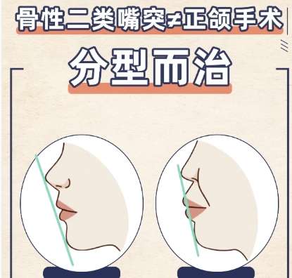 正颌
