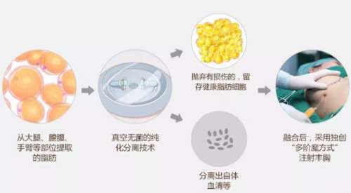脂肪丰胸 脂肪丰胸
