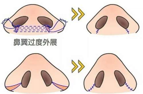 鼻翼缩小xx.jpg