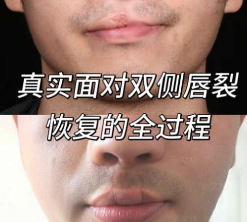 唇裂修复1.jpg