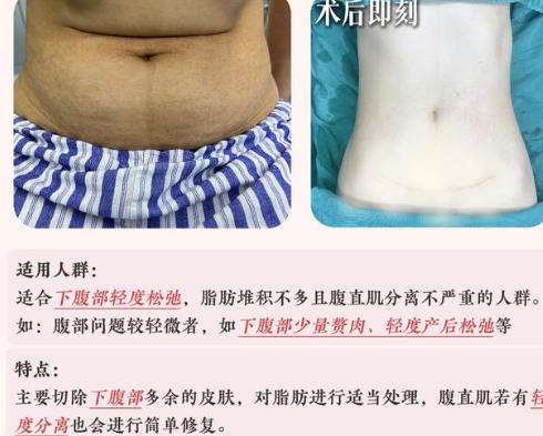腹壁1.jpg