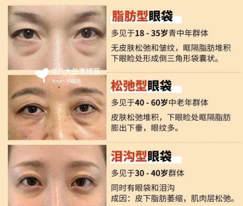 眼袋4.jpg