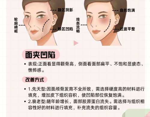 面部脂肪填充