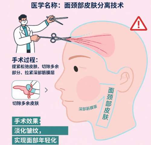 拉皮 拉皮