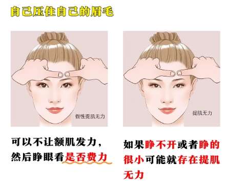 双眼皮