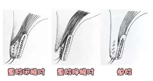 双眼皮