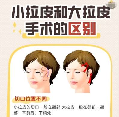 拉皮