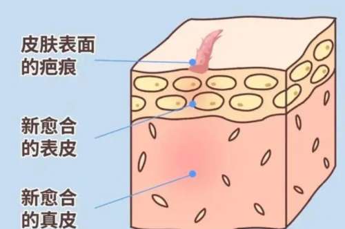 瘢痕 瘢痕