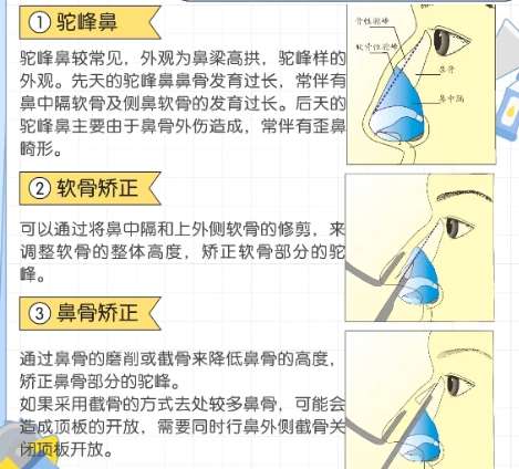 歪鼻矫正