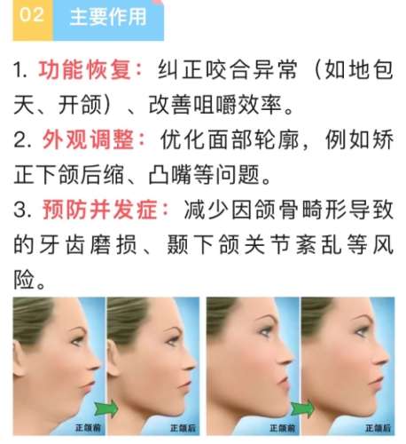 正颌手术