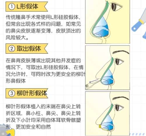 隆鼻 隆鼻