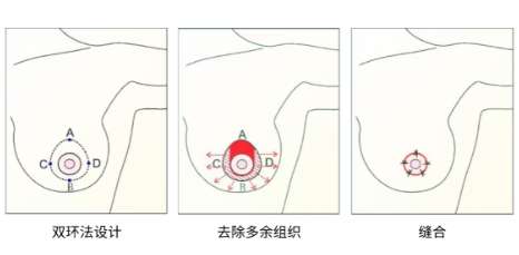 缩胸