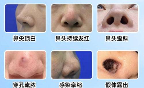 隆鼻5.jpg 隆鼻5.jpg