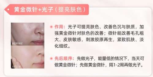 黄金微针