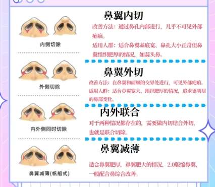 鼻翼缩小 鼻翼缩小