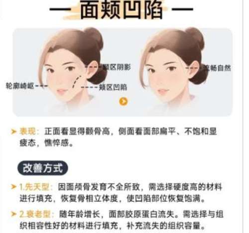 面部脂肪填充