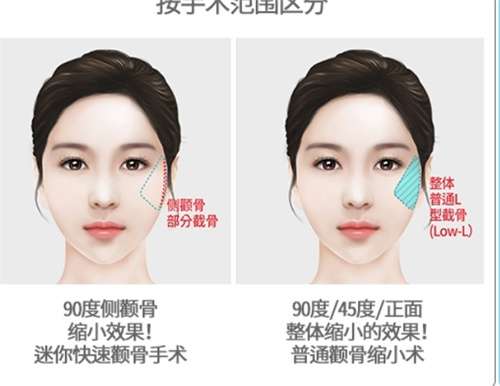 颧骨内推整形手术多少钱？预览收费明细