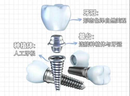 青岛种牙多少钱一颗？国产种植牙3582元起！