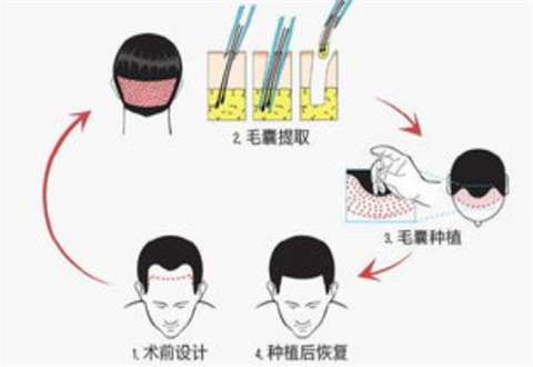 成都双禾植发有什么亮点？分析来了，直观了解案例反馈