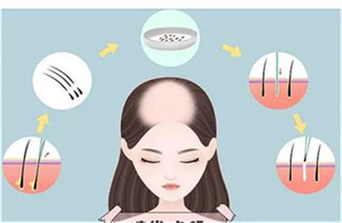 植发影响价格因素有哪些方面？都是按种植单位收费