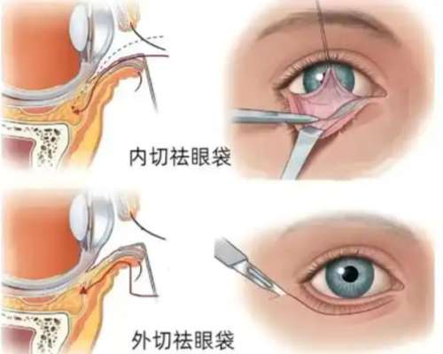 北京同仁李冬梅祛眼袋真实评价：修复型眼袋专家，价格及预约指南！