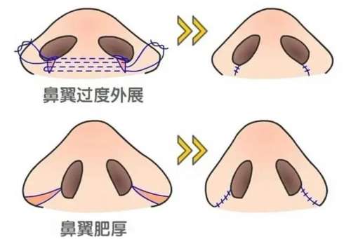 鼻翼缩小的自然方法有哪些？总有一种适合你