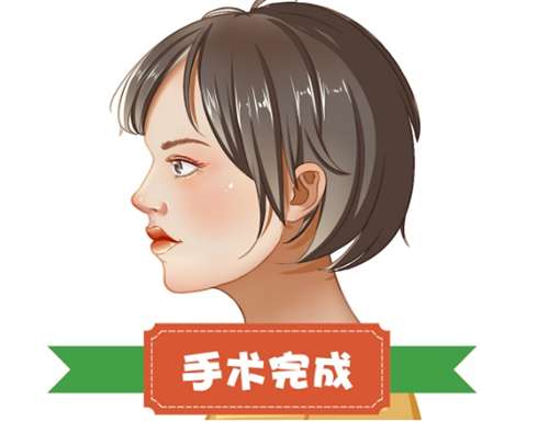 缩小鼻孔手术多少钱？3万元左右搞定鼻孔大