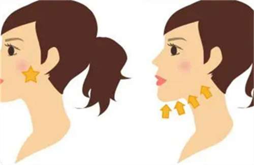 下颌角磨骨整形手术多少钱？多久能恢复？