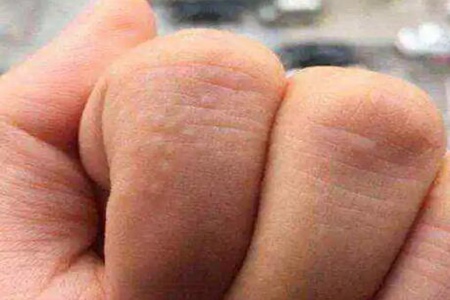 肝血管瘤症状及表现，这五个症状出现请及时就医