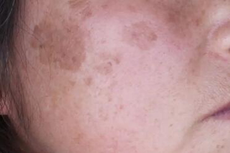 老年斑吃什么效果最好？（这五个食物能有效去除老年斑）