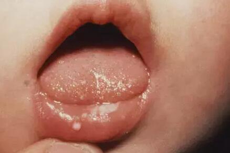 鹅口疮怎么治疗？（这三个治疗护理方法改善病症）